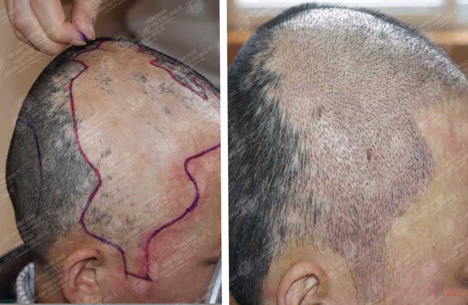  Trần Văn Lương - Cấy tóc trên sẹo 1