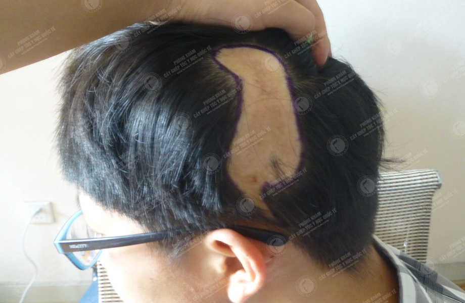 Đỗ Tuấn Minh - Cấy tóc trên sẹo 2