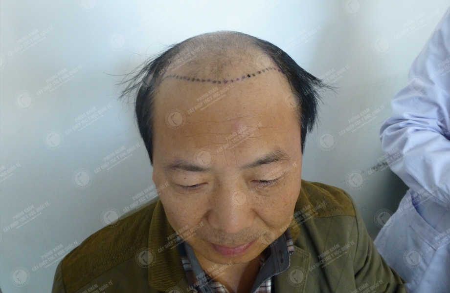 Trần Quang Đạo - Cấy tóc tự thân 2
