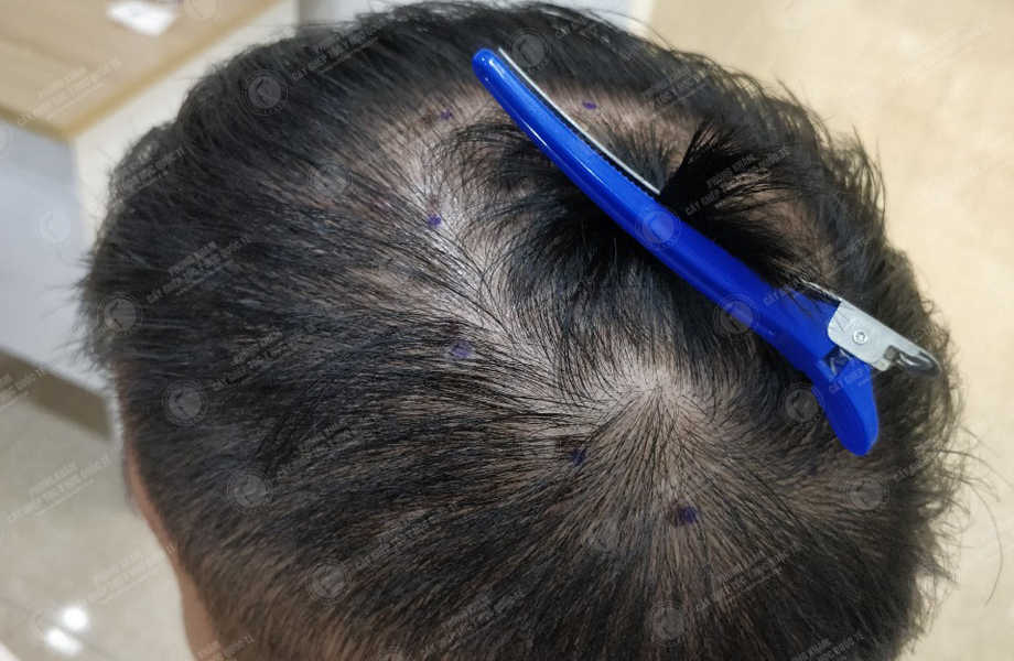 Nguyễn Văn An - Cấy tóc tự thân 2