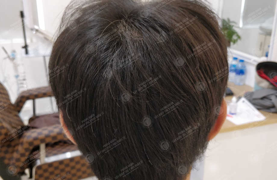 Nguyễn Khắc Toàn - Cấy tóc đường chữ M 3