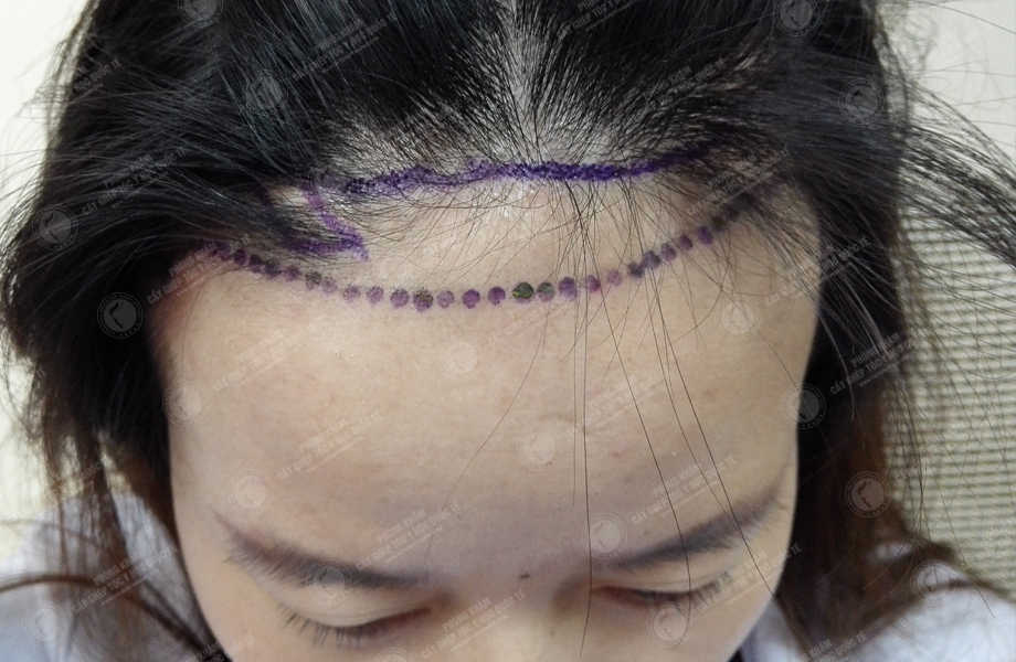 Phan Kim Ngân - Cấy tóc tự thân 2