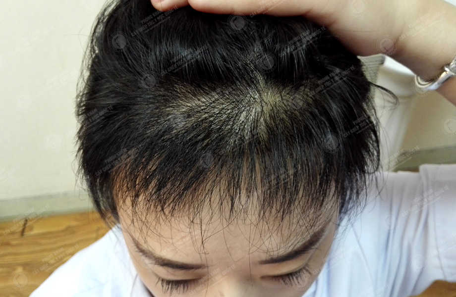 Ngô Thế Loan - Cấy tóc tự thân 6
