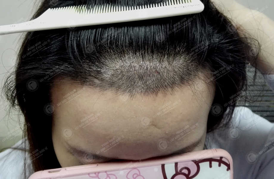  Phan Kim Ngân - Cấy tóc tự thân 1