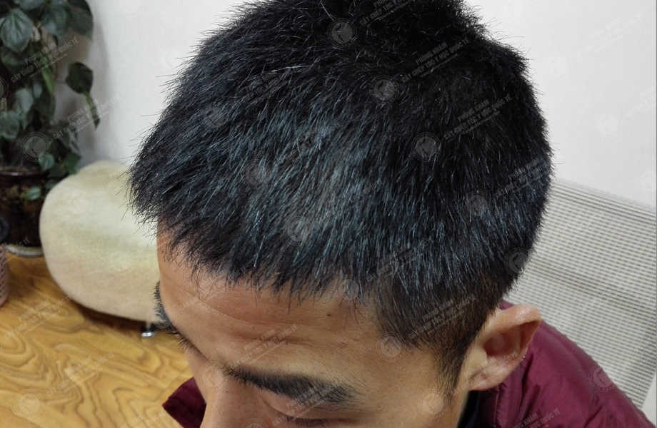 Nguyễn Quang Huy - Cấy tóc đường chữ M 7