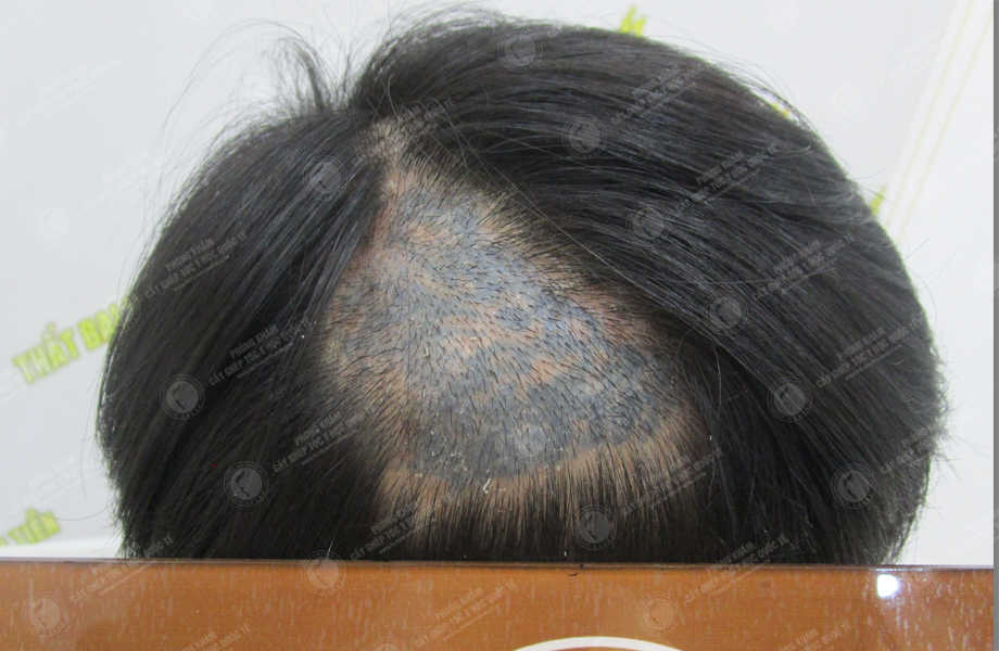 Dương Văn Huy - Cấy tóc trên sẹo 4