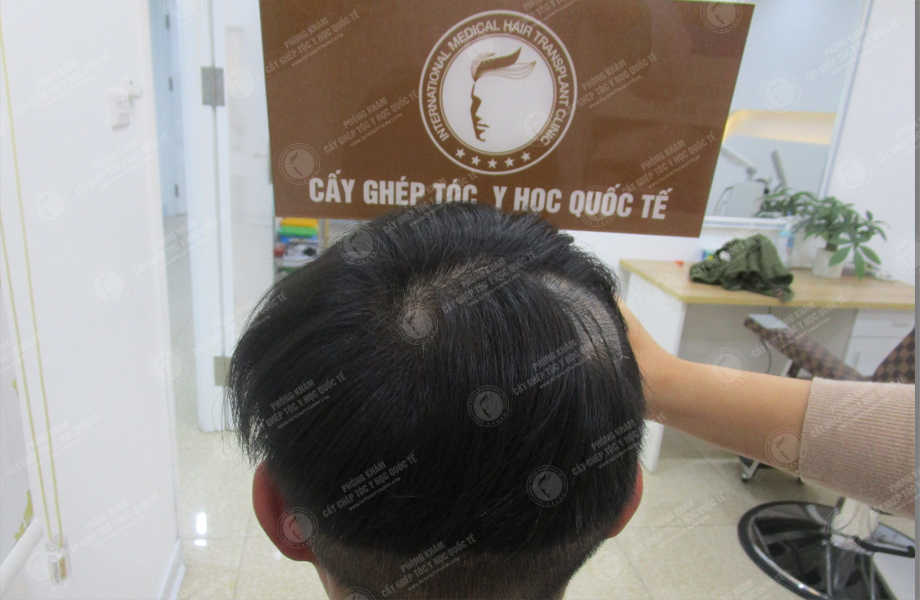 Dương Văn Huy - Cấy tóc trên sẹo 5
