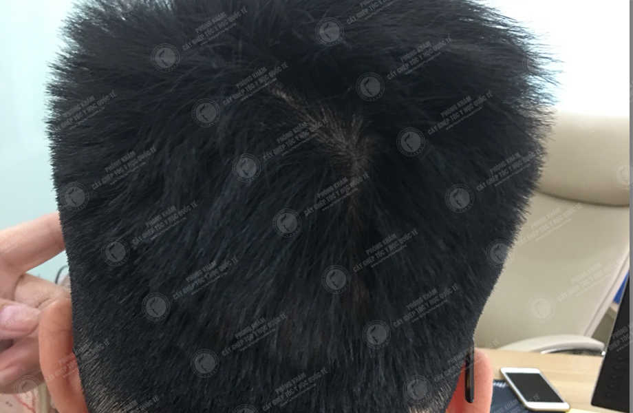 Hồ Quang Hiếu - Cấy tóc trên sẹo 5
