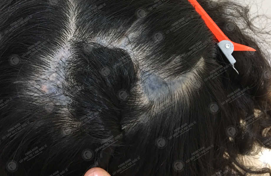 Nguyễn Thị Nga - Cấy tóc trên sẹo 2