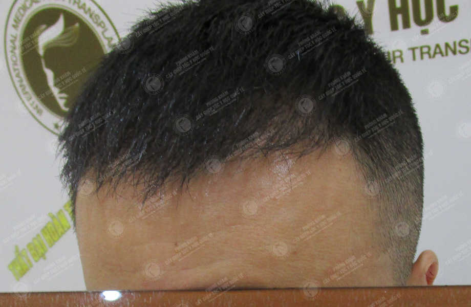 Lê Mạnh Hùng - Cấy tóc đường chữ M 5