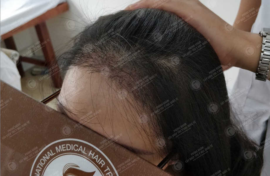 Nguyễn Thùy Giang - Cấy tóc tự thân 5