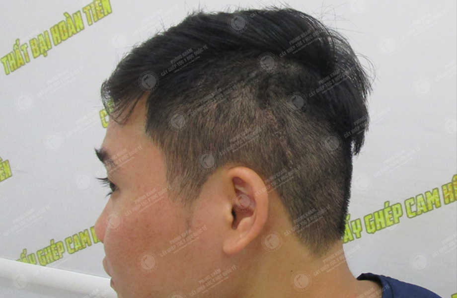 Hoàng Anh Tuấn - Cấy tóc trên sẹo 5