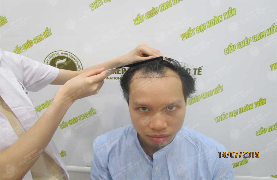 Đào Minh Chung - Cấy tóc đường chữ M 2
