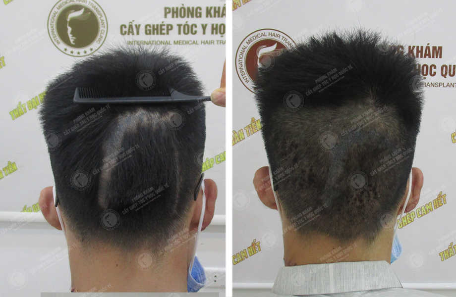  Nguyễn Sơn Tùng - Cấy tóc trên sẹo 1