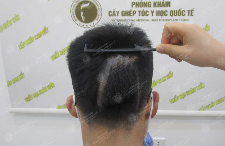 Nguyễn Sơn Tùng - Cấy tóc trên sẹo 2