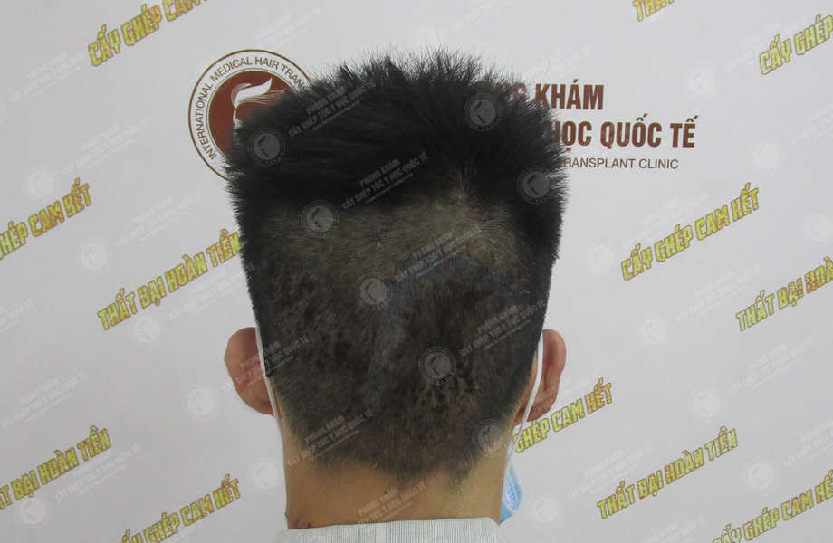 Nguyễn Sơn Tùng - Cấy tóc trên sẹo 6