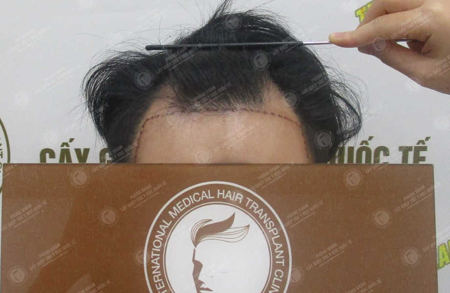 Dương Xuân Tùng - Cấy tóc đường chữ M 2