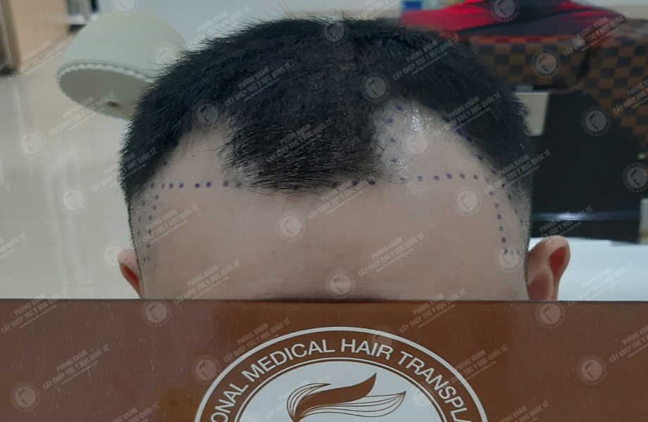 Dương Xuân Tùng - Cấy tóc đường chữ M 3