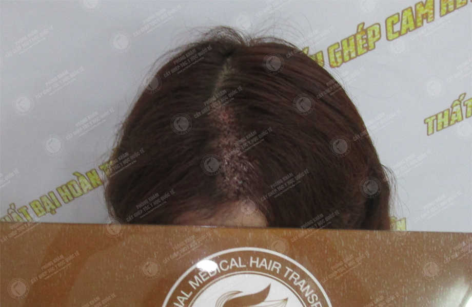 Lê Ánh Ngọc - Cấy tóc trên sẹo 2