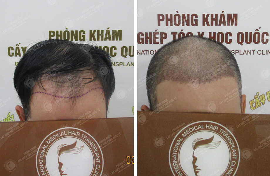  Nguyễn Quang Nam - Cấy tóc tự thân 1