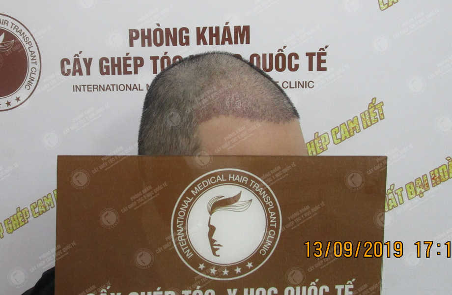 Nguyễn Quang Nam - Cấy tóc tự thân 6