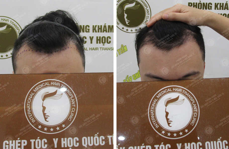  Trần Quang Đại - Cấy tóc tự thân 1