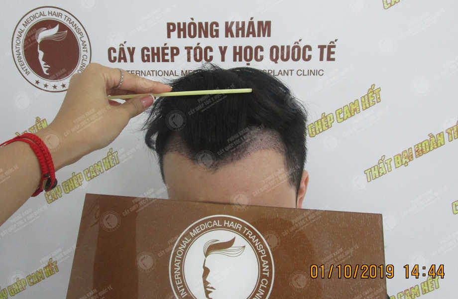 Trần Quang Đại - Cấy tóc tự thân 6