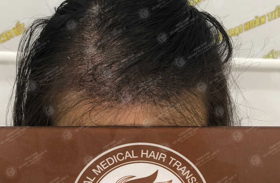 Phạm Minh Lý - Cấy tóc tự thân 7