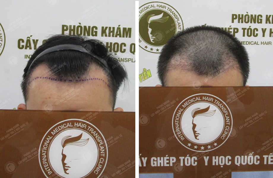  Phan Thanh Tùng - Cấy tóc đường chữ M 1