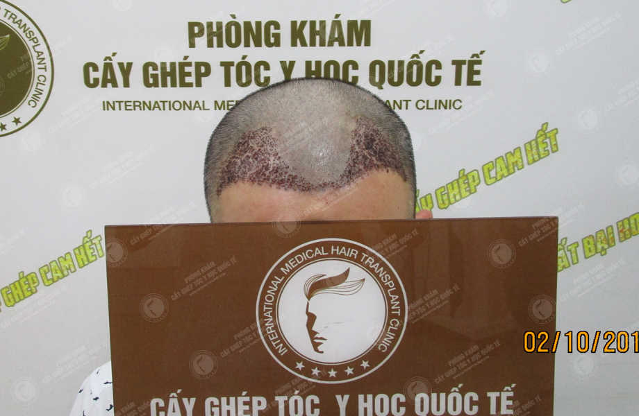 Phan Thanh Tùng - Cấy tóc đường chữ M 6