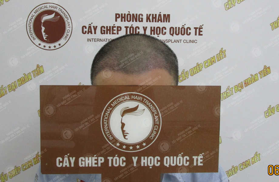 Phan Thanh Tùng - Cấy tóc đường chữ M 8