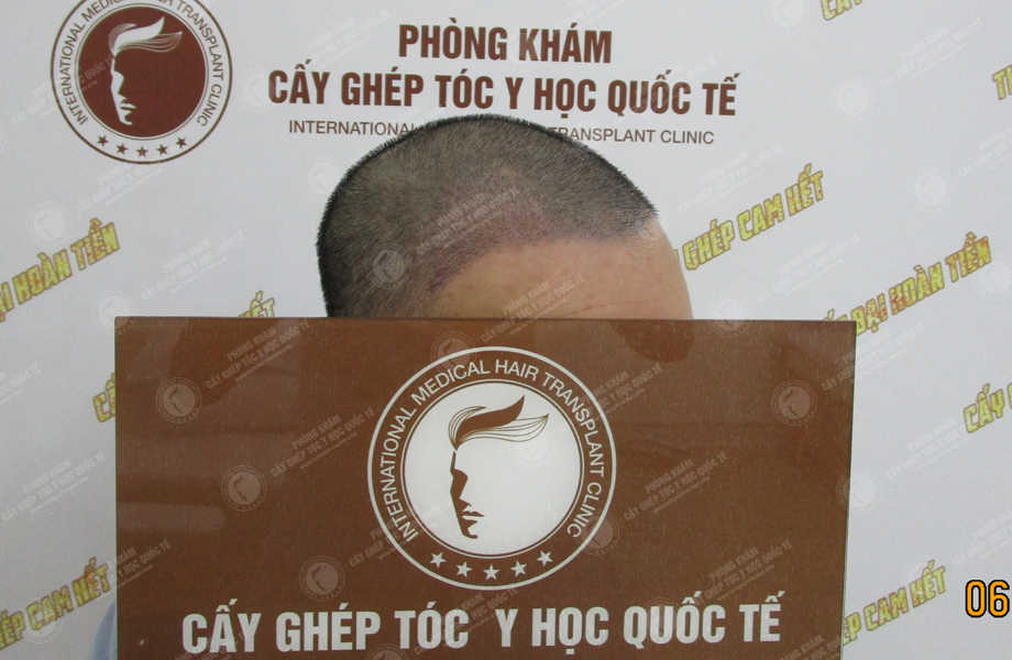 Phan Thanh Tùng - Cấy tóc đường chữ M 9