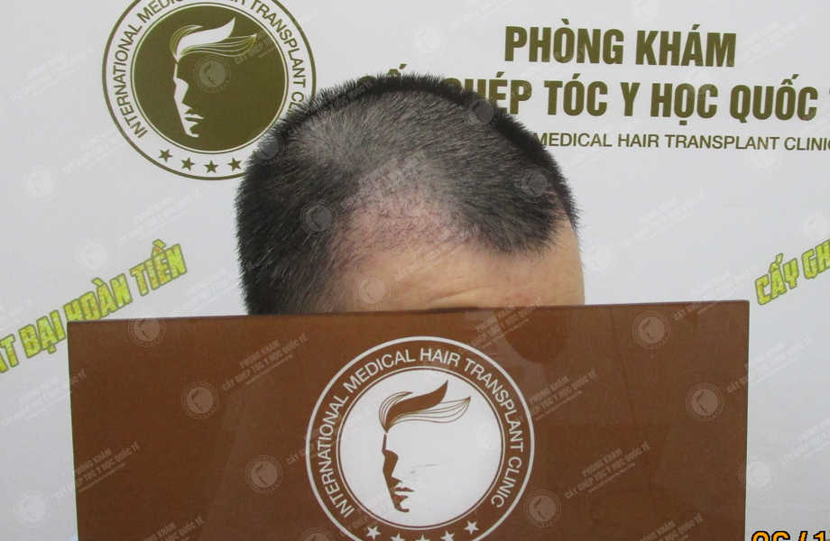 Phan Thanh Tùng - Cấy tóc đường chữ M 10