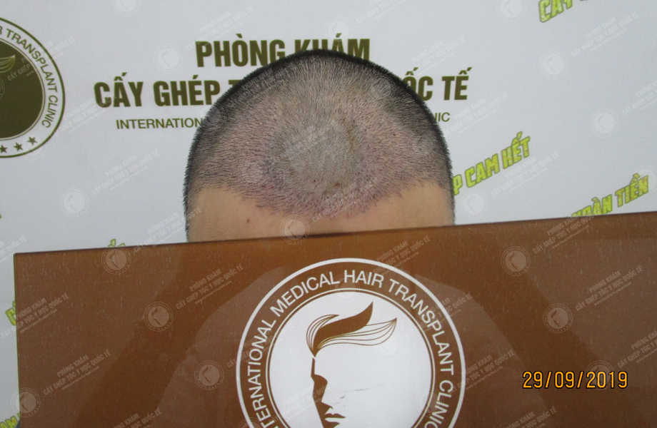 Hoàng Thanh Hưng - Cấy tóc đường chữ M 6