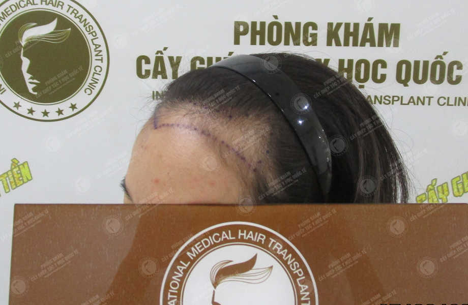 Nguyễn Thị Tình - Điều chỉnh đường chân tóc 2