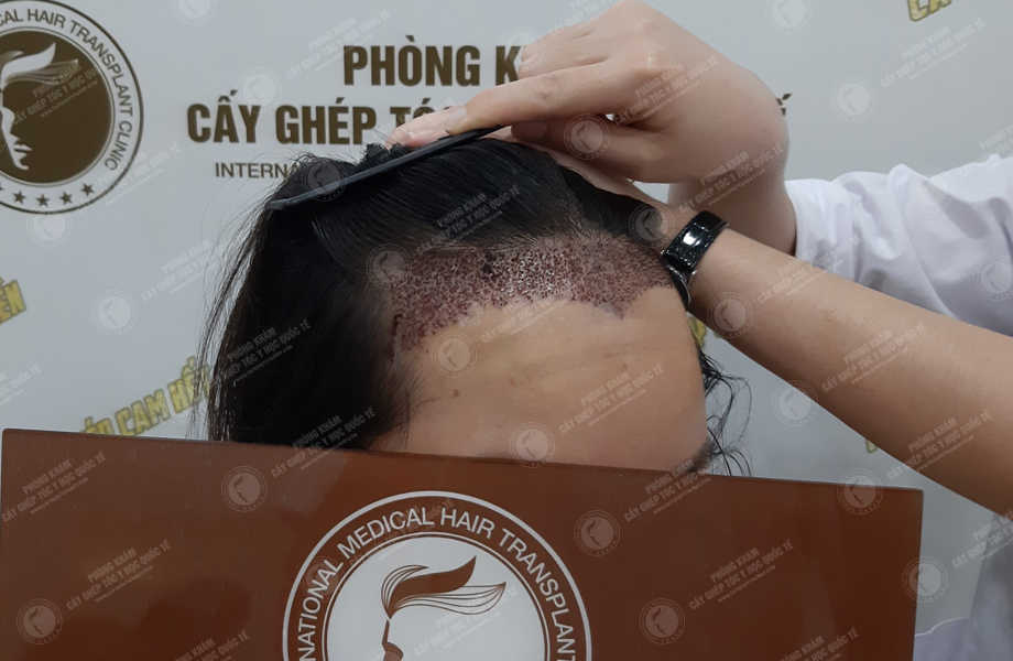 Nguyễn Thị Tình - Điều chỉnh đường chân tóc 7