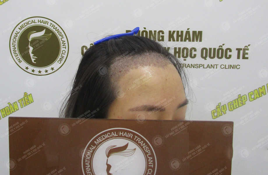 Nguyễn Thị Tình - Điều chỉnh đường chân tóc 9