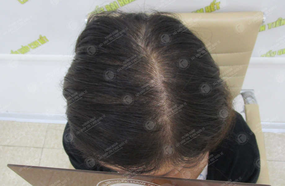Phạm Thùy Trang - Cấy tóc tự thân 2