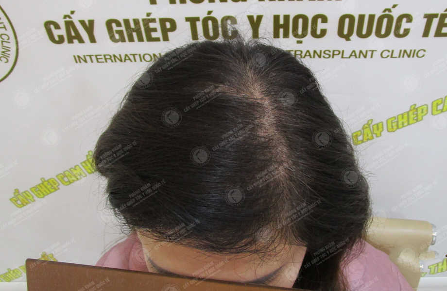 Phạm Thùy Trang - Cấy tóc tự thân 8