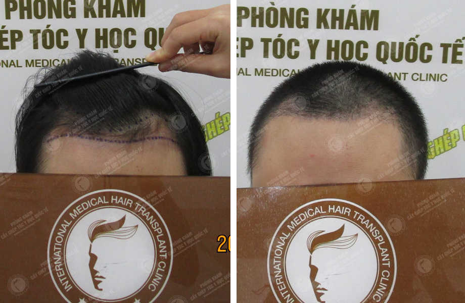  Trần Mạnh Đoàn - Cấy tóc đường chữ M 1