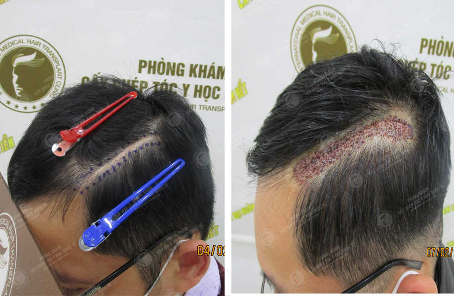  Nguyễn Xuân Dương - Cấy tóc trên sẹo 1