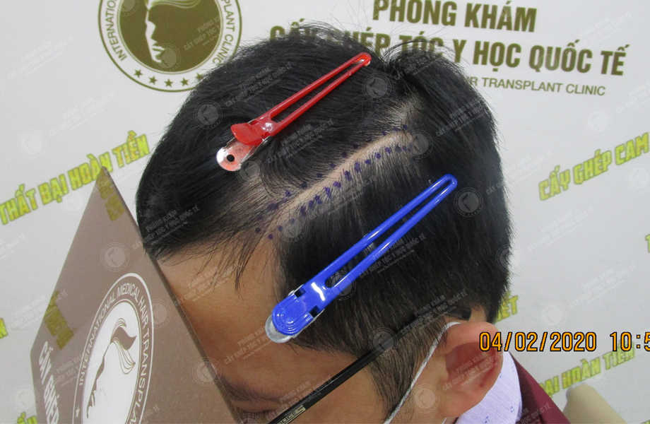 Nguyễn Xuân Dương - Cấy tóc trên sẹo 2