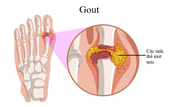 Bệnh Gout (gút): Nguyên nhân, triệu chứng, chẩn đoán và điều trị