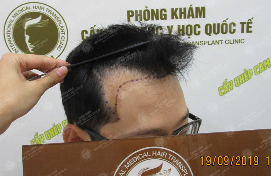 Trần Khánh Hưng - Cấy tóc tự thân 3