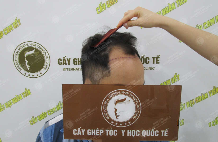 Trịnh Thanh Sơn - Cấy tóc tự thân 2