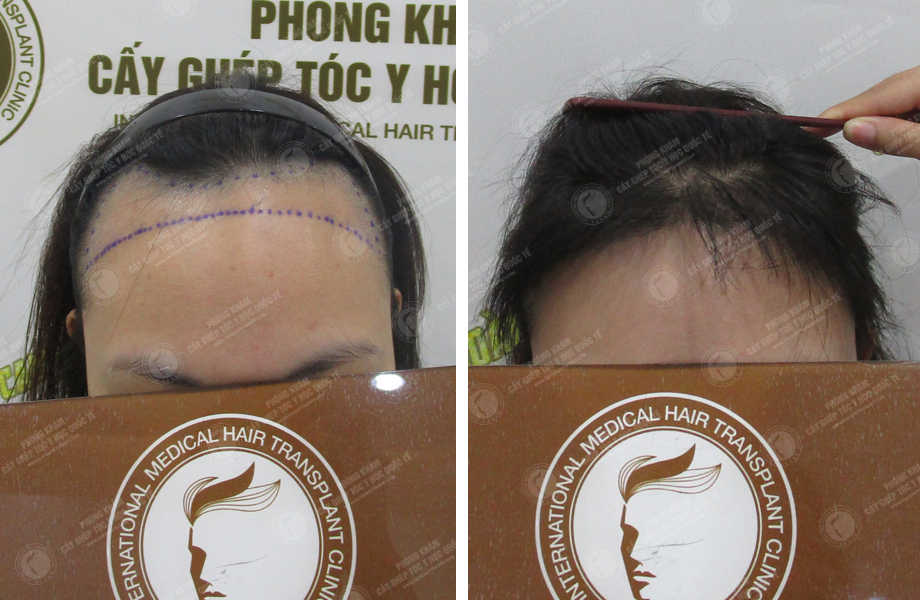  Phạm Hồng Loan - Điều chỉnh đường chân tóc 1
