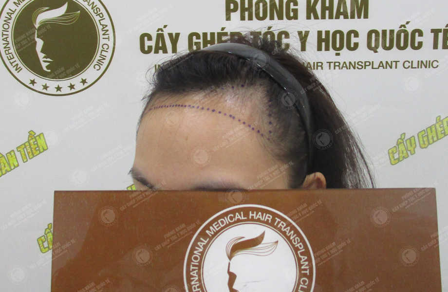 Phạm Hồng Loan - Điều chỉnh đường chân tóc 4