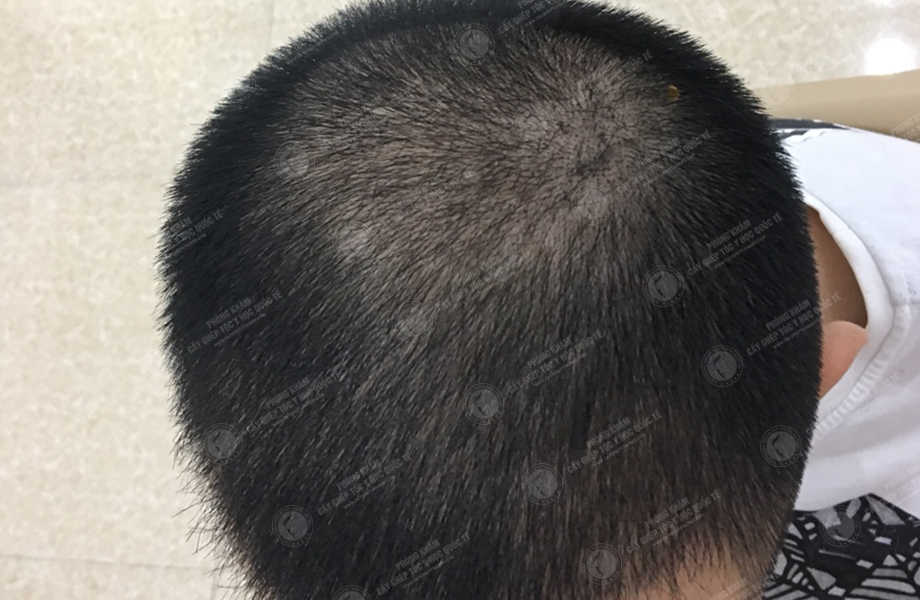 Trần Việt Hùng - Cấy tóc tự thân 7