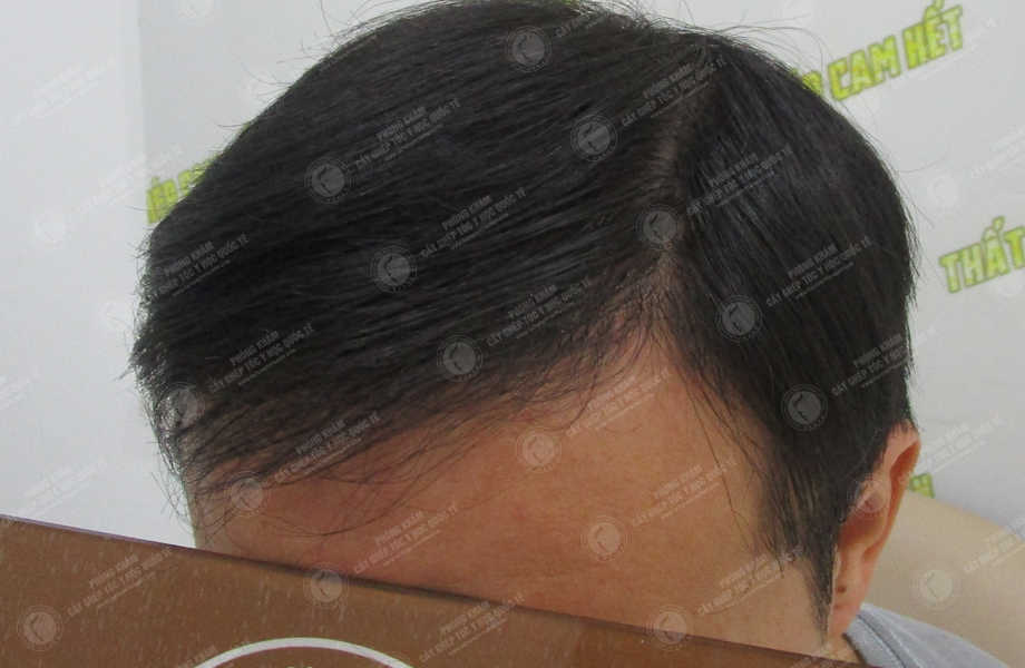 Vũ Xuân Vinh - Cấy tóc đường chữ M 15