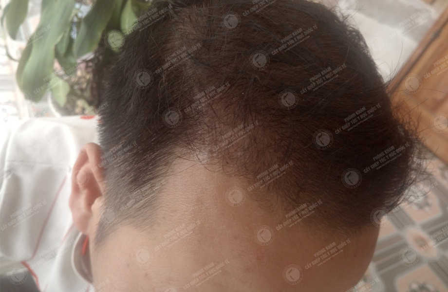 Lê Đăng Huyền - Cấy tóc tự thân 10